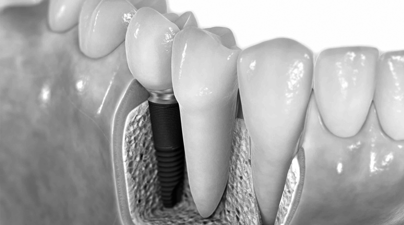 Imagen de cursos de salud Anatomía Dental en Implantología El curso de Salud Anatomía Dental en Implantología forma parte de nuestro catálogo de cursos de Alebat Education