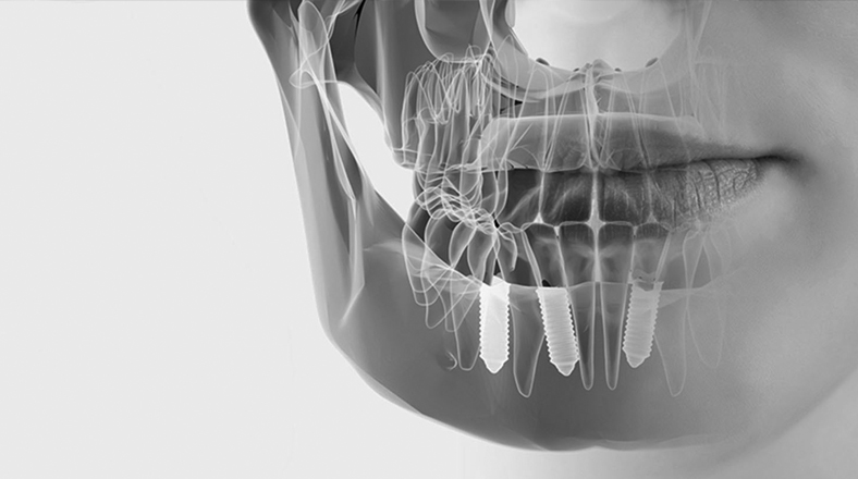 Imagen de cursos de odontología Complicaciones en Implantología El curso de odontología Complicaciones en Implantología forma parte de nuestro catálogo de cursos de Knotgroup Dental Institute