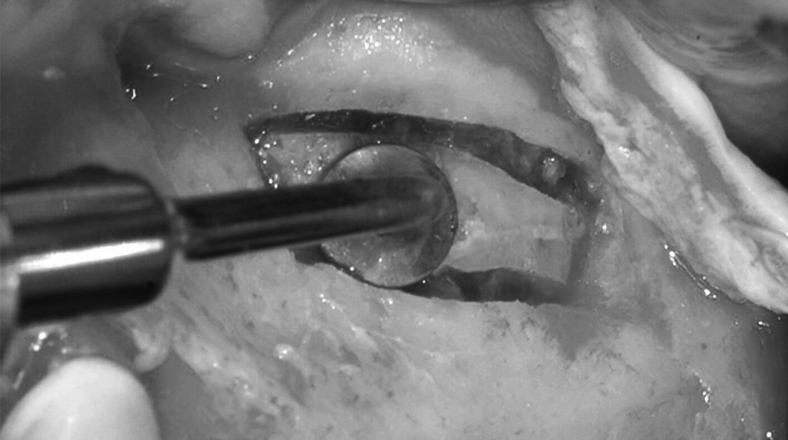 Imagen de cursos de odontología Elevación de Seno El curso de odontología Elevación de Seno forma parte de nuestro catálogo de cursos de Knotgroup Dental Institute