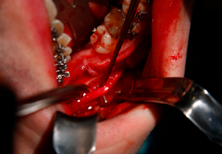 Imagen del Máster en Cirugía Ortognática de Alebat Education Master cirugia ortognatica odontologia realizado por los profesores de Alebat Education
