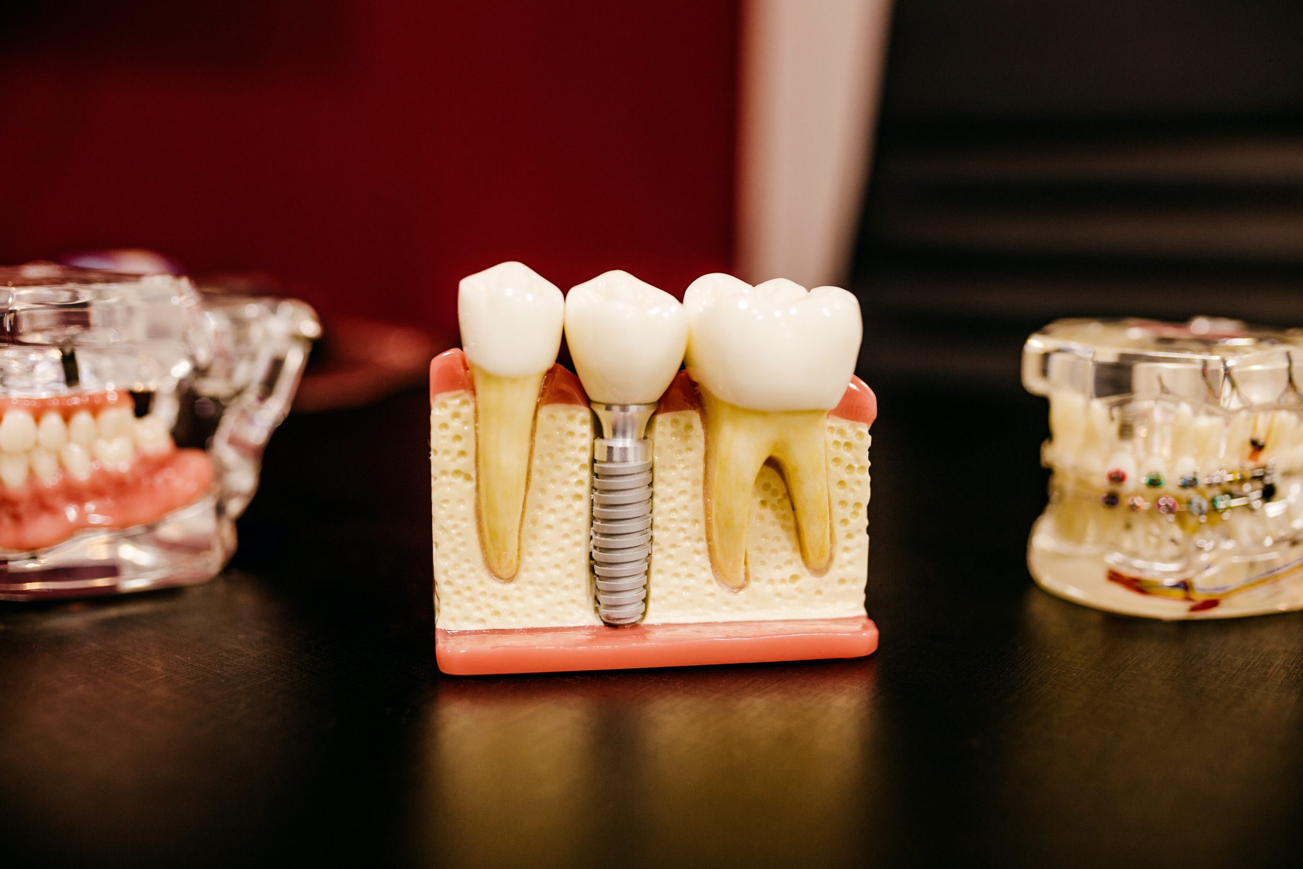 Consideraciones para la colocación de Implantes