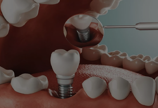 Ventajas de los Implantes Dentales
